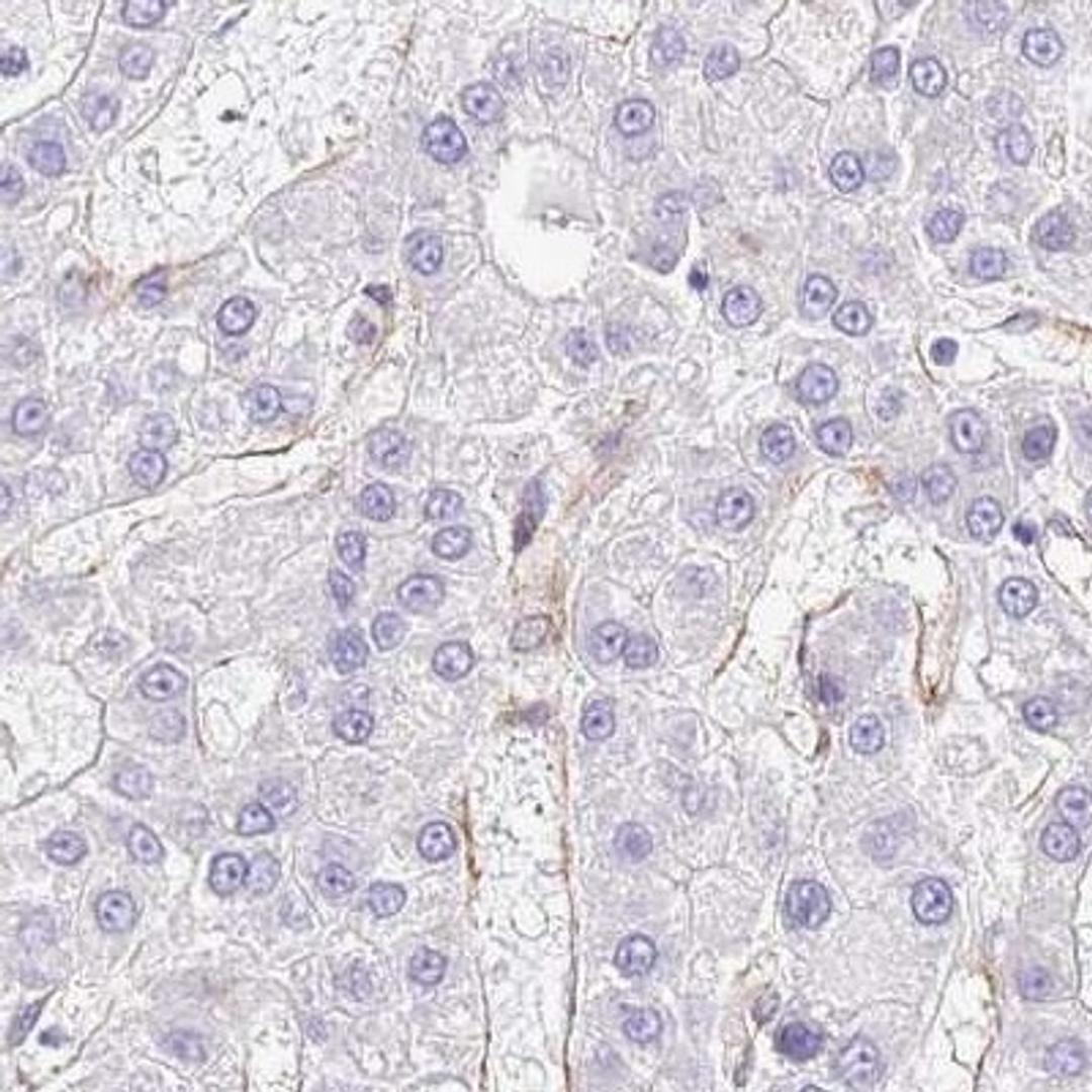 Immunohistochemistry: CTDSPL Antibody [NBP2-31913] - liver cancer