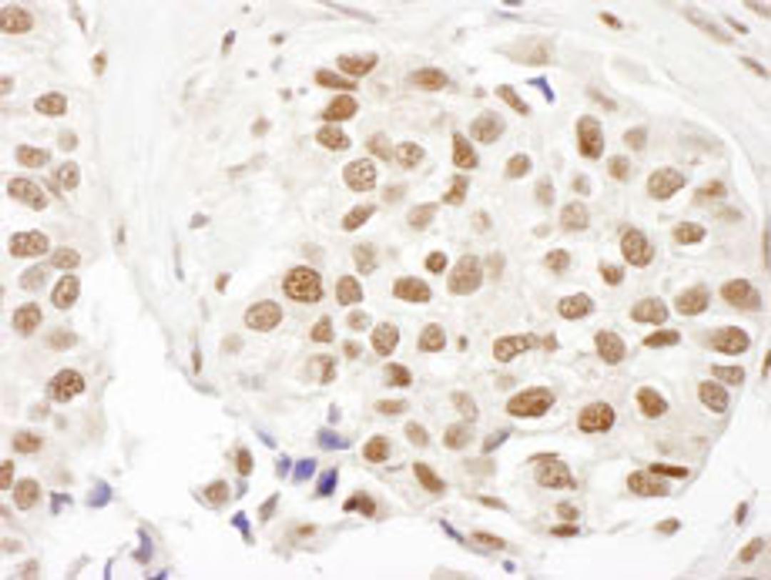 Detection of human FANCD2 by immunohistochemistry.