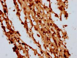 IHC image of CSB-PA010429OA05nbhbHU diluted at 1:10 and staining in paraffin-embedded human melanoma performed on a Leica BondTM system. After dewaxing and hydration, antigen retrieval was mediated by high pressure in a citrate buffer (pH 6.0). Section was blocked with 10% normal goat serum 30min at RT. Then primary antibody (1% BSA) was incubated at 4&deg;C overnight. The primary is detected by a biotinylated secondary antibody and visualized using an HRP conjugated SP system.