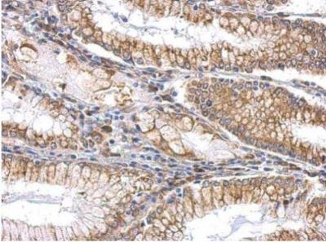 Immunohistochemistry-Paraffin: Slit2 Antibody [NBP2-20398] - SLIT2 Antibody [NBP2-20398] -  Cytosol and membrane on gastric carcinoma .