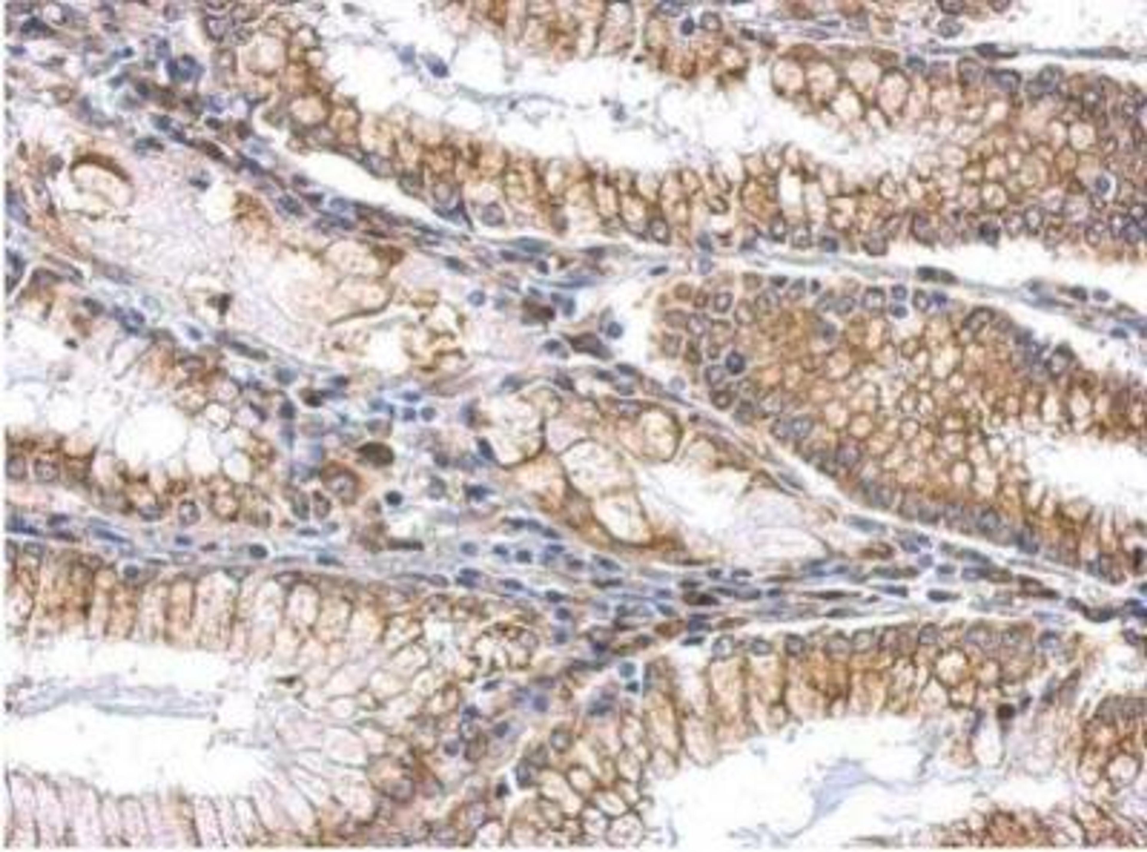 Immunohistochemistry-Paraffin: Slit2 Antibody [NBP2-20398] - SLIT2 Antibody [NBP2-20398] -  Cytosol and membrane on gastric carcinoma .