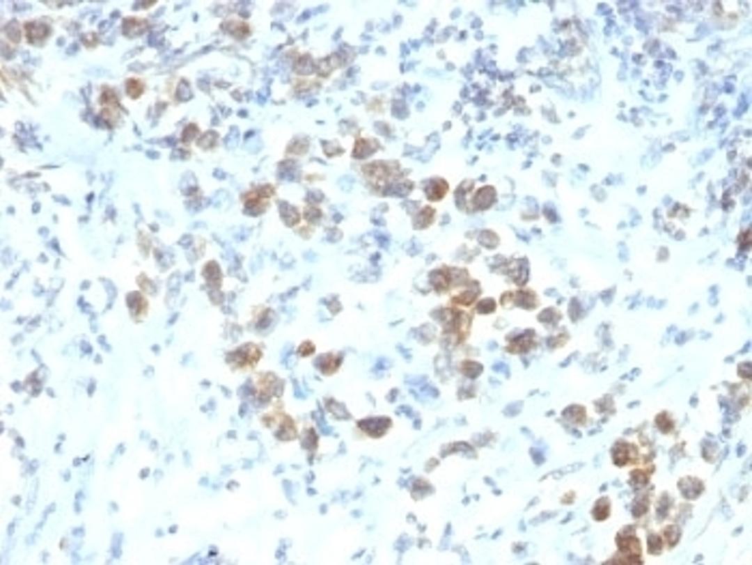 Formalin-fixed, paraffin-embedded human gastric carcinoma stained with PAX-6 antibody (SPM612).