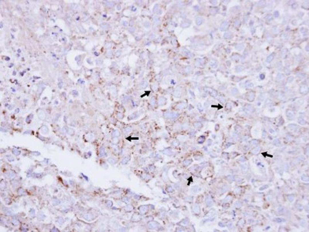 Immunohistochemistry-Paraffin: MTMR2 Antibody [NBP1-33724] - Paraffin-embedded CL1-0 xenograft, using antibody at 1:100 dilution.