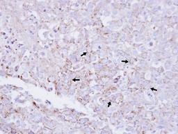 Immunohistochemistry-Paraffin: MTMR2 Antibody [NBP1-33724] - Paraffin-embedded CL1-0 xenograft, using antibody at 1:100 dilution.