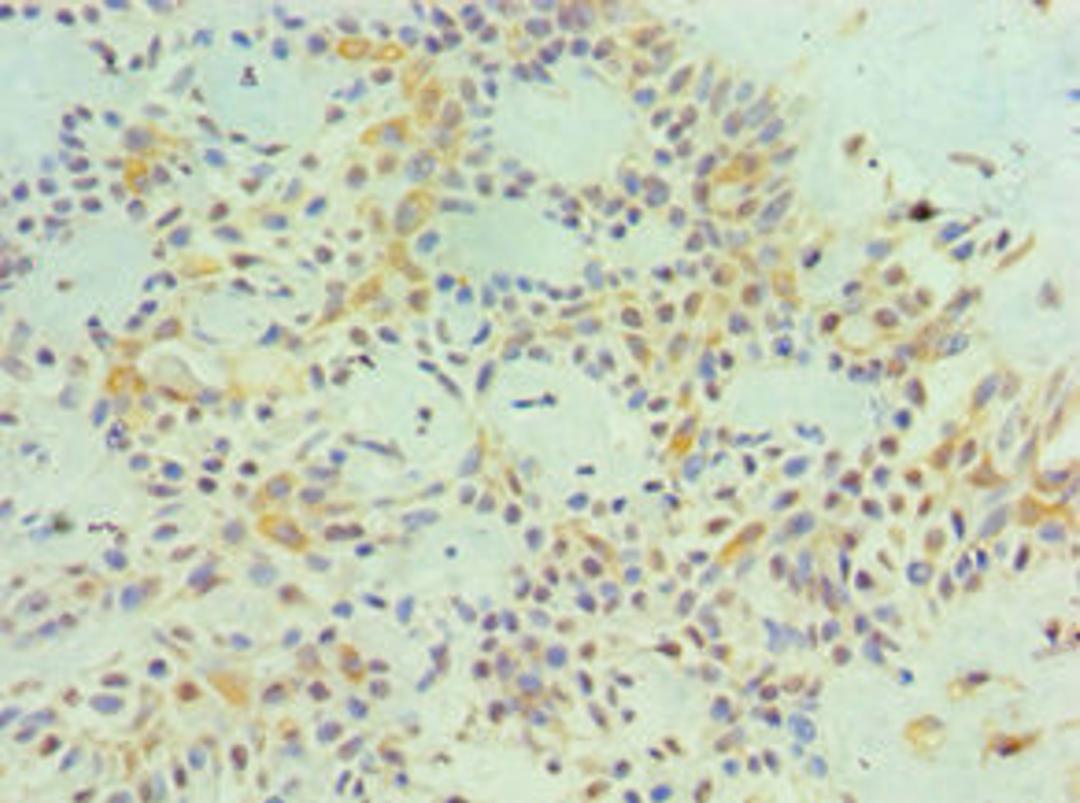 Immunohistochemistry of paraffin-embedded human breast cancer using CSB-PA013323ESR2HU at dilution of 1:100