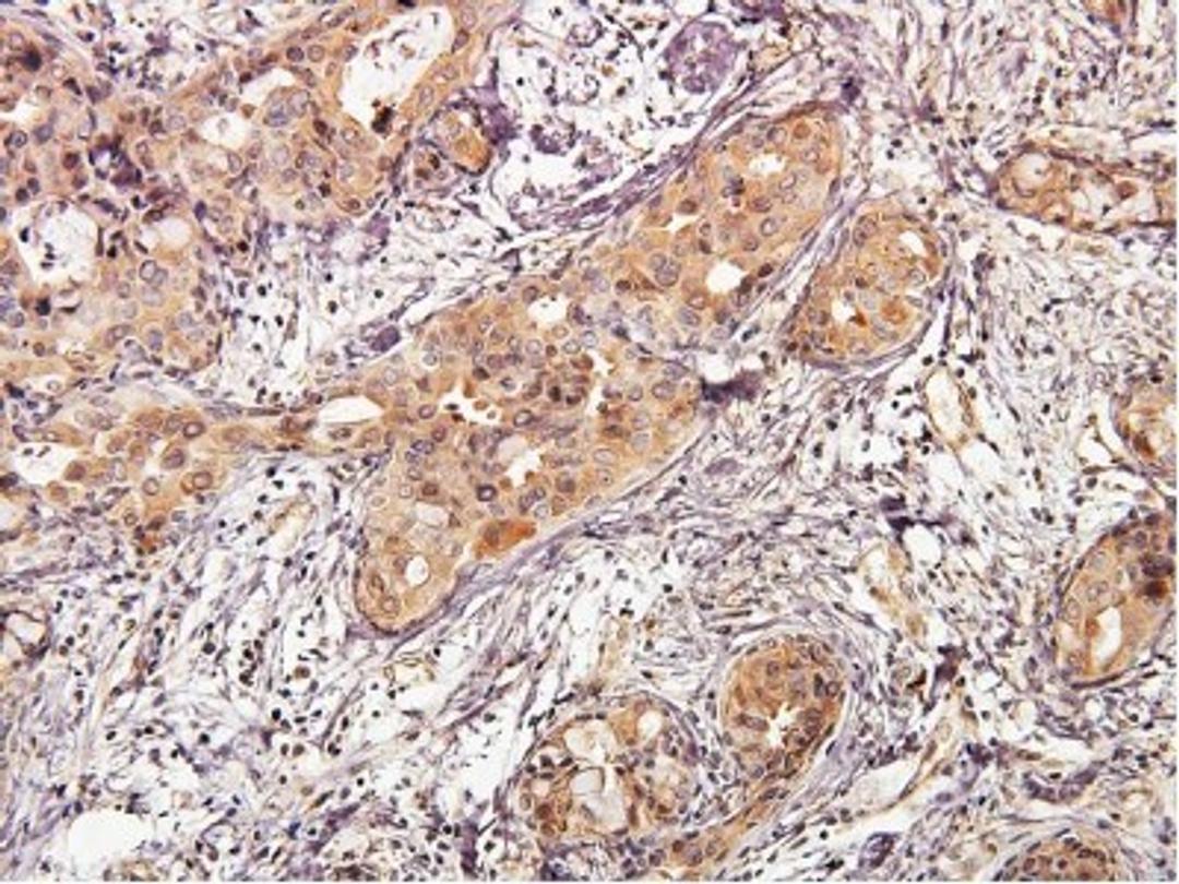 Immunohistochemistry-Paraffin: Akt1 Antibody (3A3) [NBP1-51602] - IHC analysis of paraffin-embedded human breast carcinoma using AKT1 antibody at dilution of 1:50. Image from verified customer review.