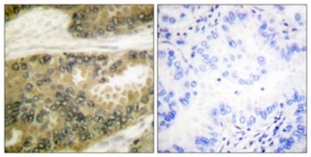 Immunohistochemistry-Paraffin: Cyclin D3 Antibody [NBP1-61286] - Analysis of paraffin-embedded human lung carcinoma tissue, using Cyclin D3  Antibody. The picture on the right is treated with the synthesized peptide.