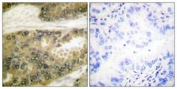 Immunohistochemistry-Paraffin: Cyclin D3 Antibody [NBP1-61286] - Analysis of paraffin-embedded human lung carcinoma tissue, using Cyclin D3  Antibody. The picture on the right is treated with the synthesized peptide.