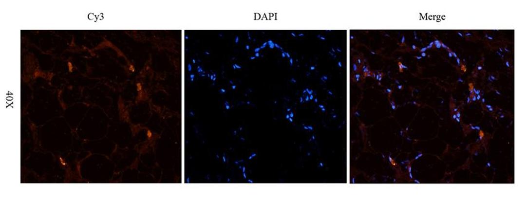 Immunofluorescence image of human endometrial cancer tissue using anti-HOXA10 (2.5 ug/ml)