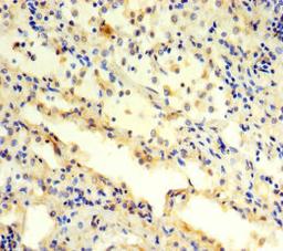 Immunohistochemistry of paraffin-embedded human lung cancer using CSB-PA018891LA01HU at dilution of 1:100