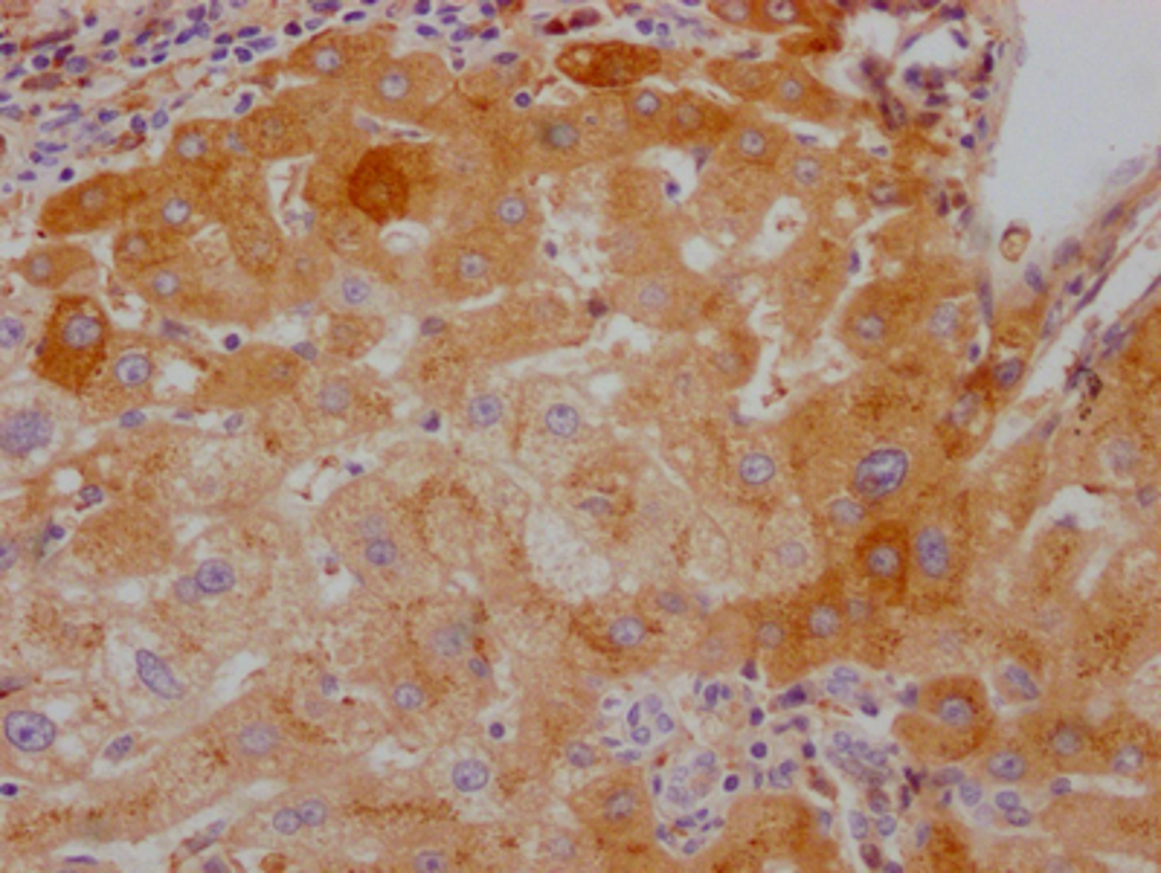 IHC image of CSB-RA599469A0HU diluted at 1:100 and staining in paraffin-embedded human liver cancer performed on a Leica BondTM system. After dewaxing and hydration, antigen retrieval was mediated by high pressure in a citrate buffer (pH 6.0). Section was blocked with 10% normal goat serum 30min at RT. Then primary antibody (1% BSA) was incubated at 4℃ overnight. The primary is detected by a Goat anti-rabbit IgG polymer labeled by HRP and visualized using 0.05% DAB.