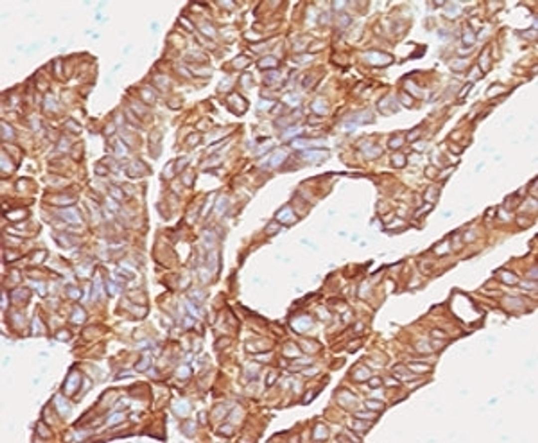 IHC testing of human colorectal carcinoma with anti-EpCAM antibody (clone EPM17-2).