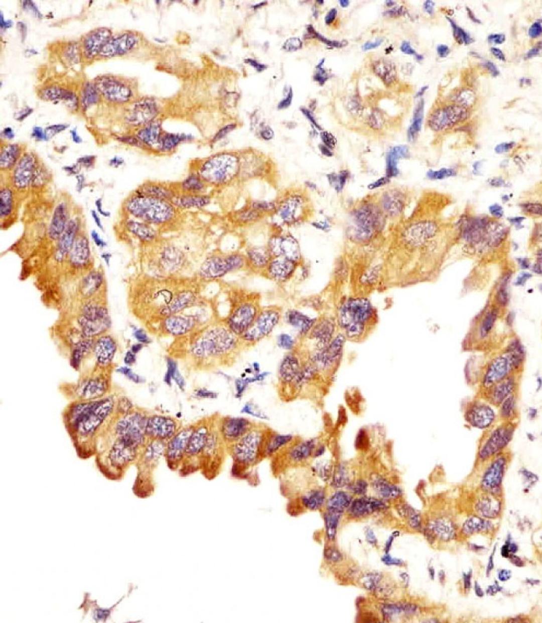 Antibody staining SFTPC in human lung adenocarcinoma sections by Immunohistochemistry (IHC-P - paraformaldehyde-fixed, paraffin-embedded sections).