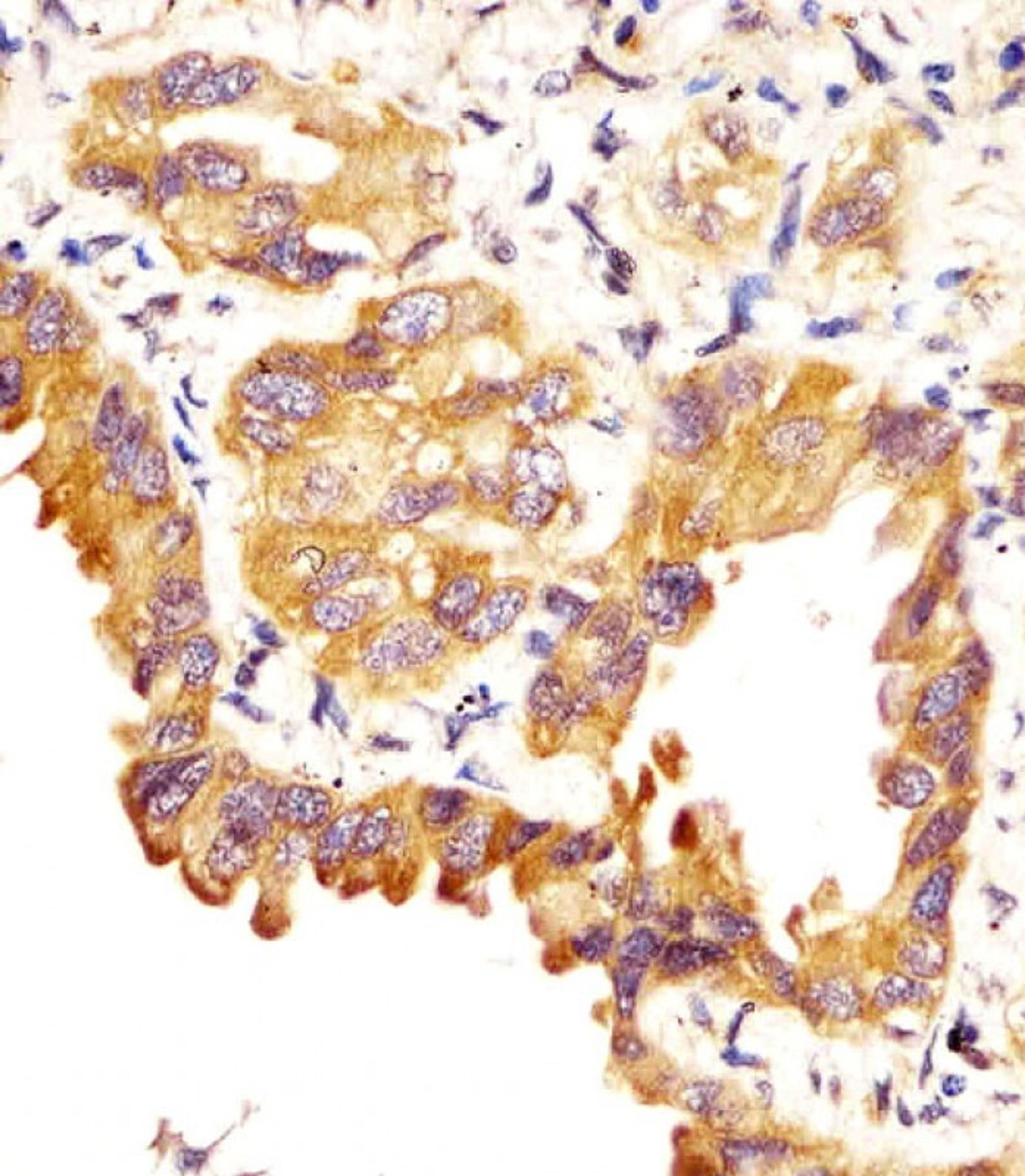 Antibody staining SFTPC in human lung adenocarcinoma sections by Immunohistochemistry (IHC-P - paraformaldehyde-fixed, paraffin-embedded sections).