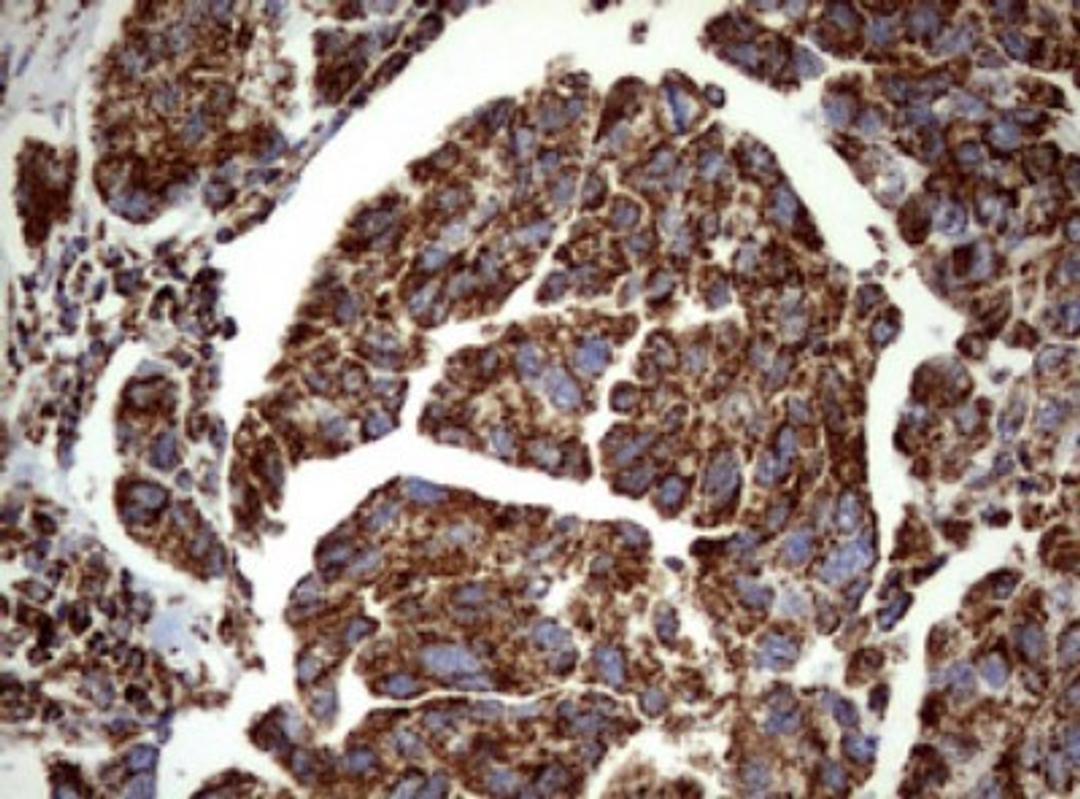 Immunohistochemistry: PI 3-Kinase p110 delta Antibody (1D11) [NBP2-46404] - Analysis of Carcinoma of Human bladder tissue. (Heat-induced epitope retrieval by 1 mM EDTA in 10mM Tris, pH8.5, 120C for 3min)