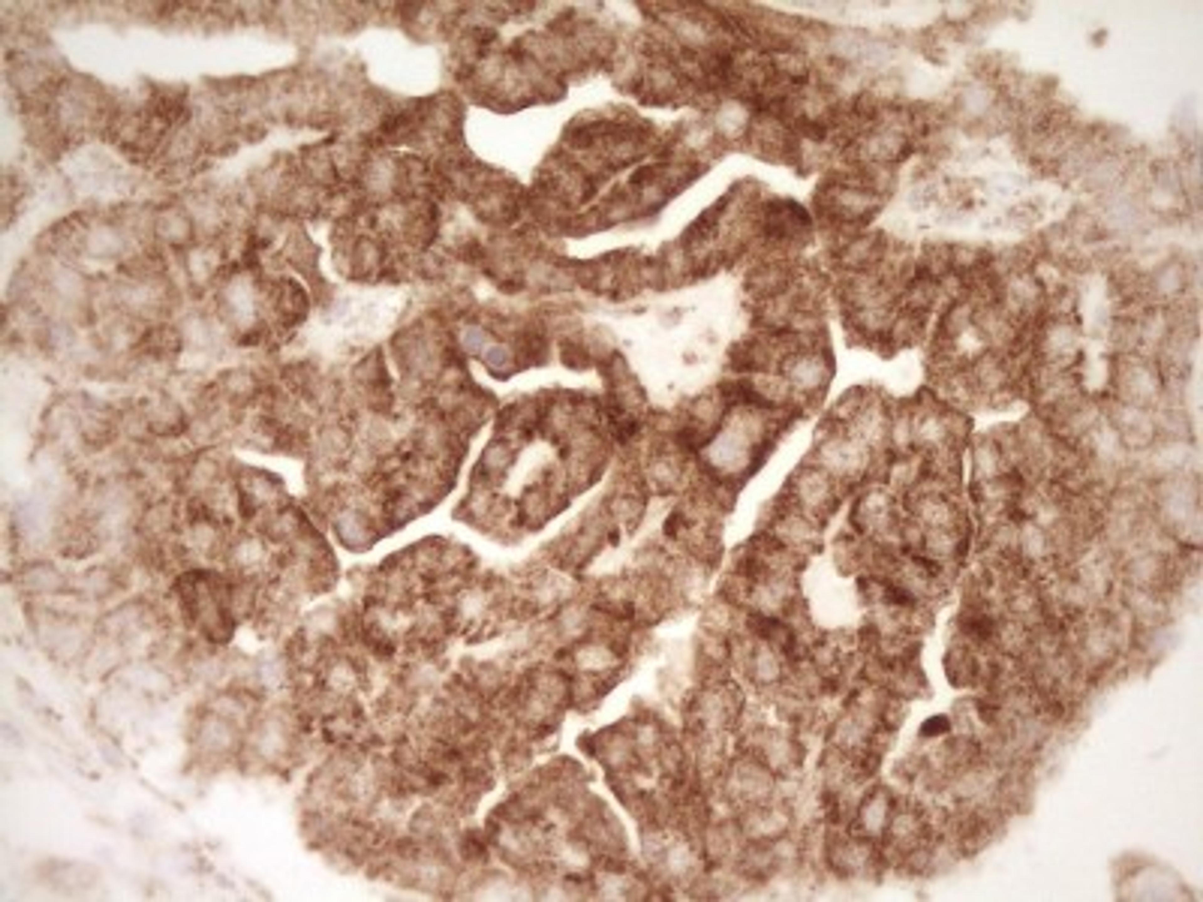 Immunohistochemistry: sFRP-2 Antibody (6C2) [NBP2-45804] - Analysis of Adenocarcinoma of Human ovary tissue. (Heat-induced epitope retrieval by 1 mM EDTA in 10mM Tris, pH8.5, 120C for 3min)