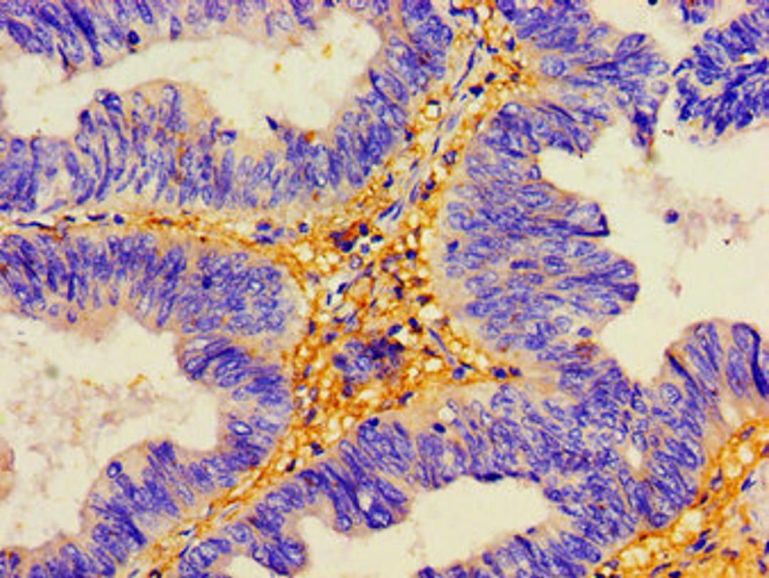 Immunohistochemistry of paraffin-embedded human colon cancer using CSB-PA622752LA01HU at dilution of 1:100