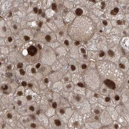 Immunohistochemistry: LAGE3 Antibody [NBP2-32715] - liver cancer