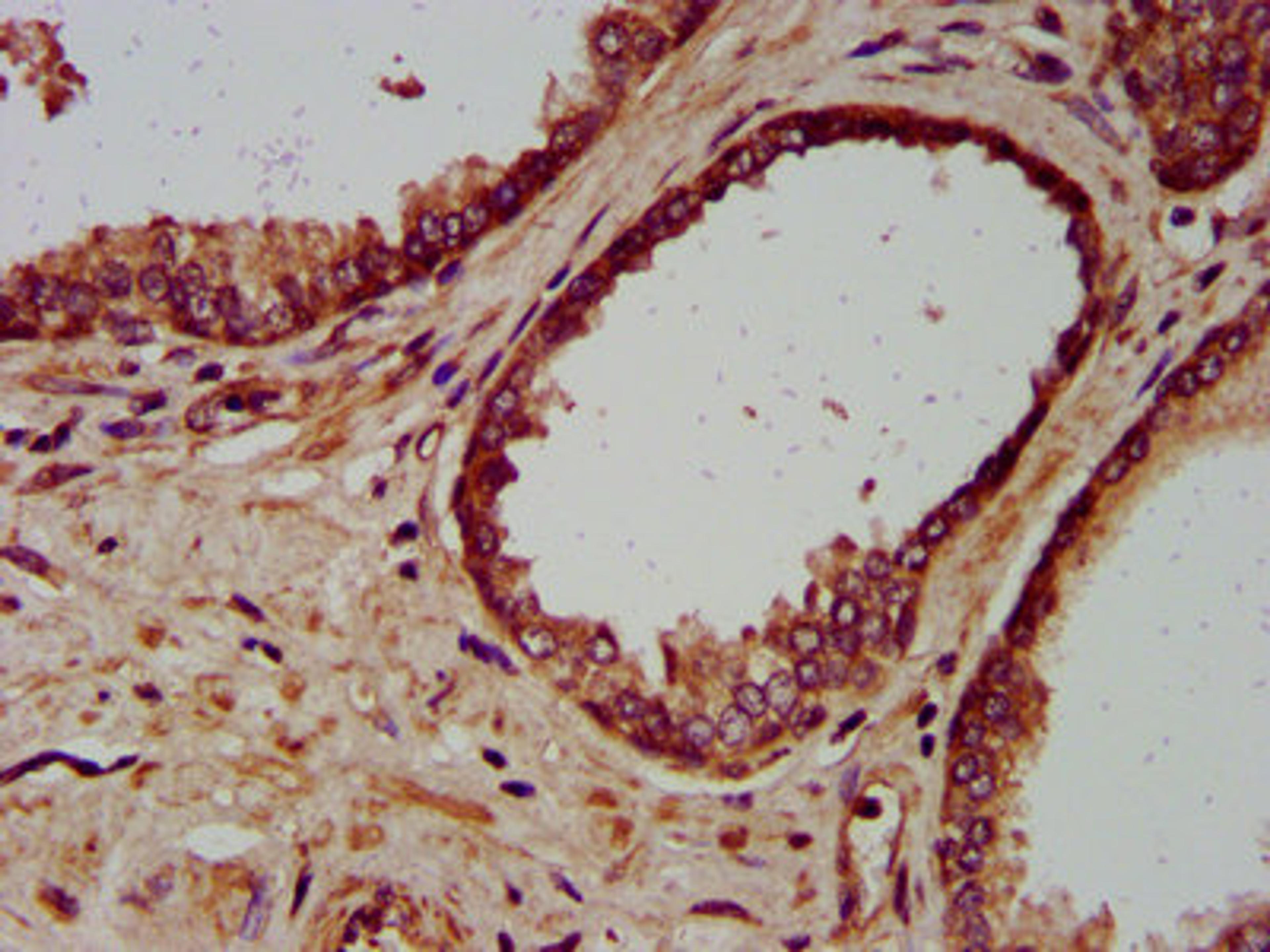 IHC image of CSB-PA013834LA01HU diluted at 1:200 and staining in paraffin-embedded human prostate cancer performed on a Leica BondTM system. After dewaxing and hydration, antigen retrieval was mediated by high pressure in a citrate buffer (pH 6.0). Section was blocked with 10% normal goat serum 30min at RT. Then primary antibody (1% BSA) was incubated at 4&deg;C overnight. The primary is detected by a biotinylated secondary antibody and visualized using an HRP conjugated SP system.