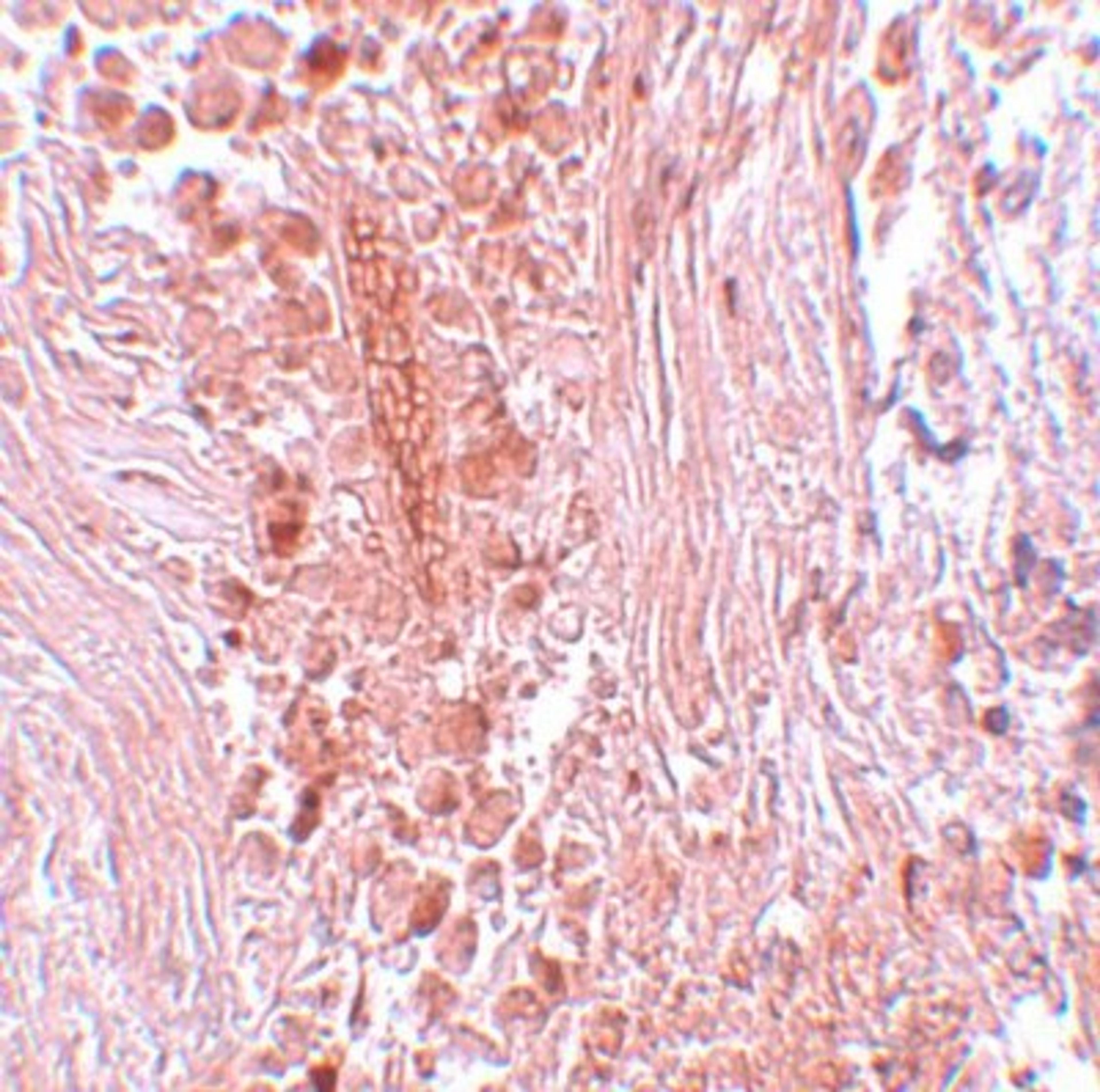 Immunohistochemistry-Paraffin: PIAS3 Antibody [NBP1-77160] - Human breast carcinoma tissue with PIAS3 antibody at 5 ug/mL.