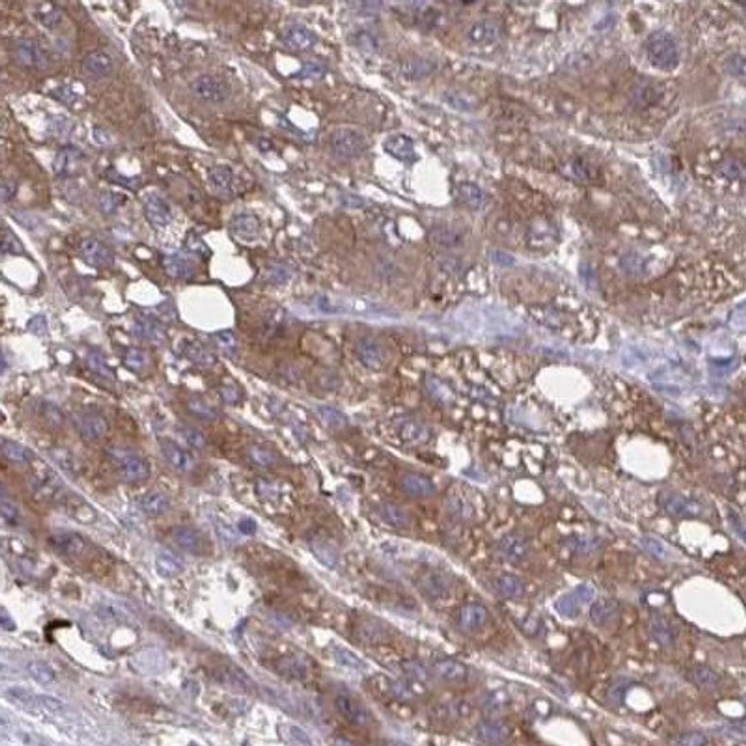 Immunohistochemistry: SNF8 Antibody [NBP2-32449] - liver cancer