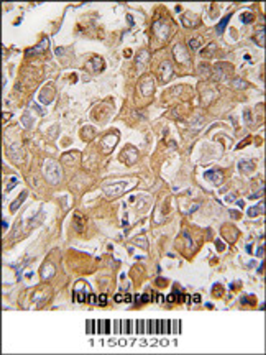 Formalin-fixed and paraffin-embedded human lung carcinoma tissue reacted with LECT1 antibody , which was peroxidase-conjugated to the secondary antibody, followed by DAB staining.