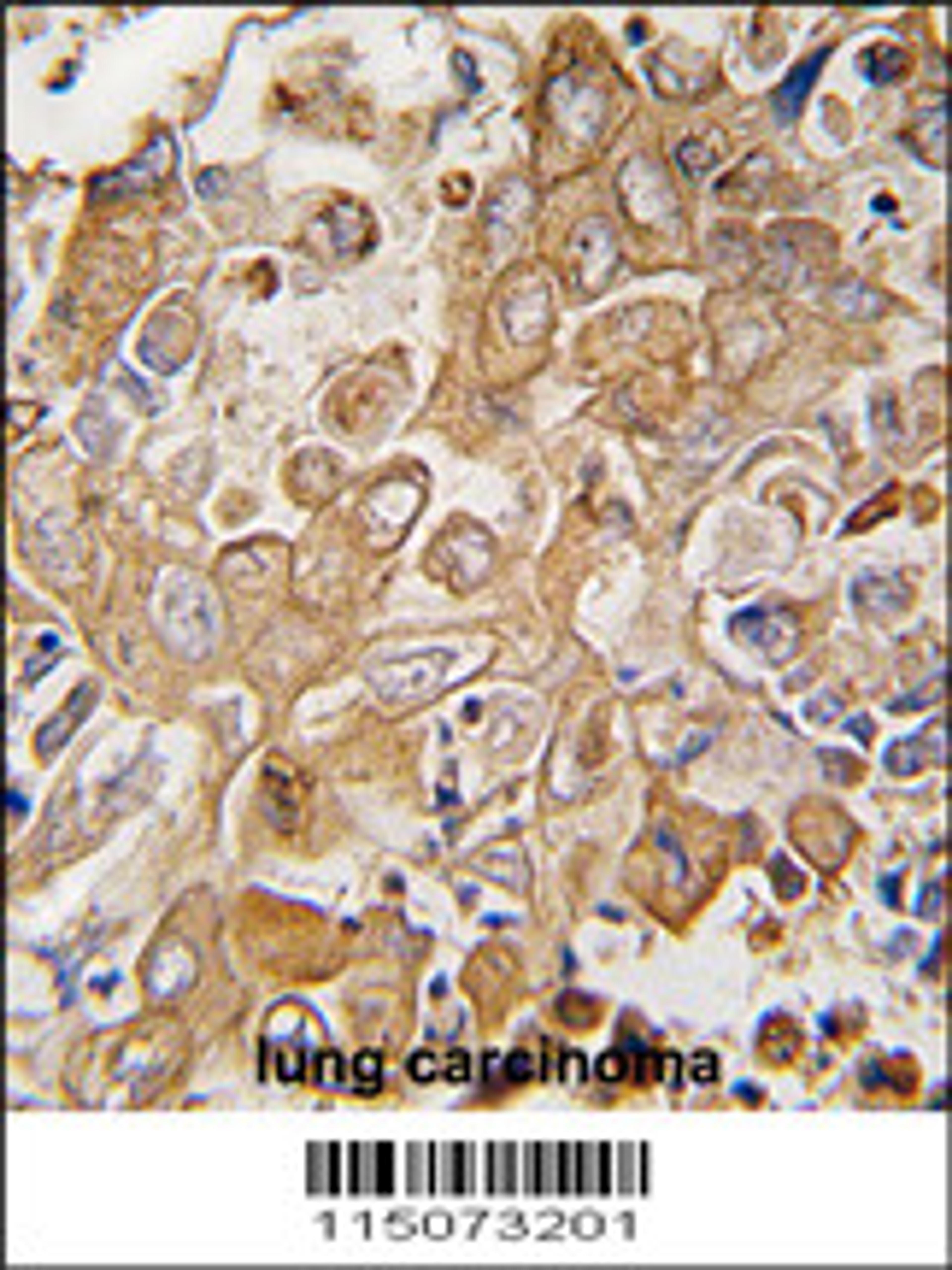 Formalin-fixed and paraffin-embedded human lung carcinoma tissue reacted with LECT1 antibody , which was peroxidase-conjugated to the secondary antibody, followed by DAB staining.