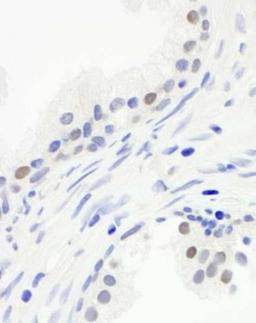 Immunohistochemistry: Cdc20 Antibody [NB100-59827] - FFPE section of human prostate carcinoma.  Antibody used at a dilution of 1:250. Detection: DAB staining using Immunohistochemistry Accessory Kit.