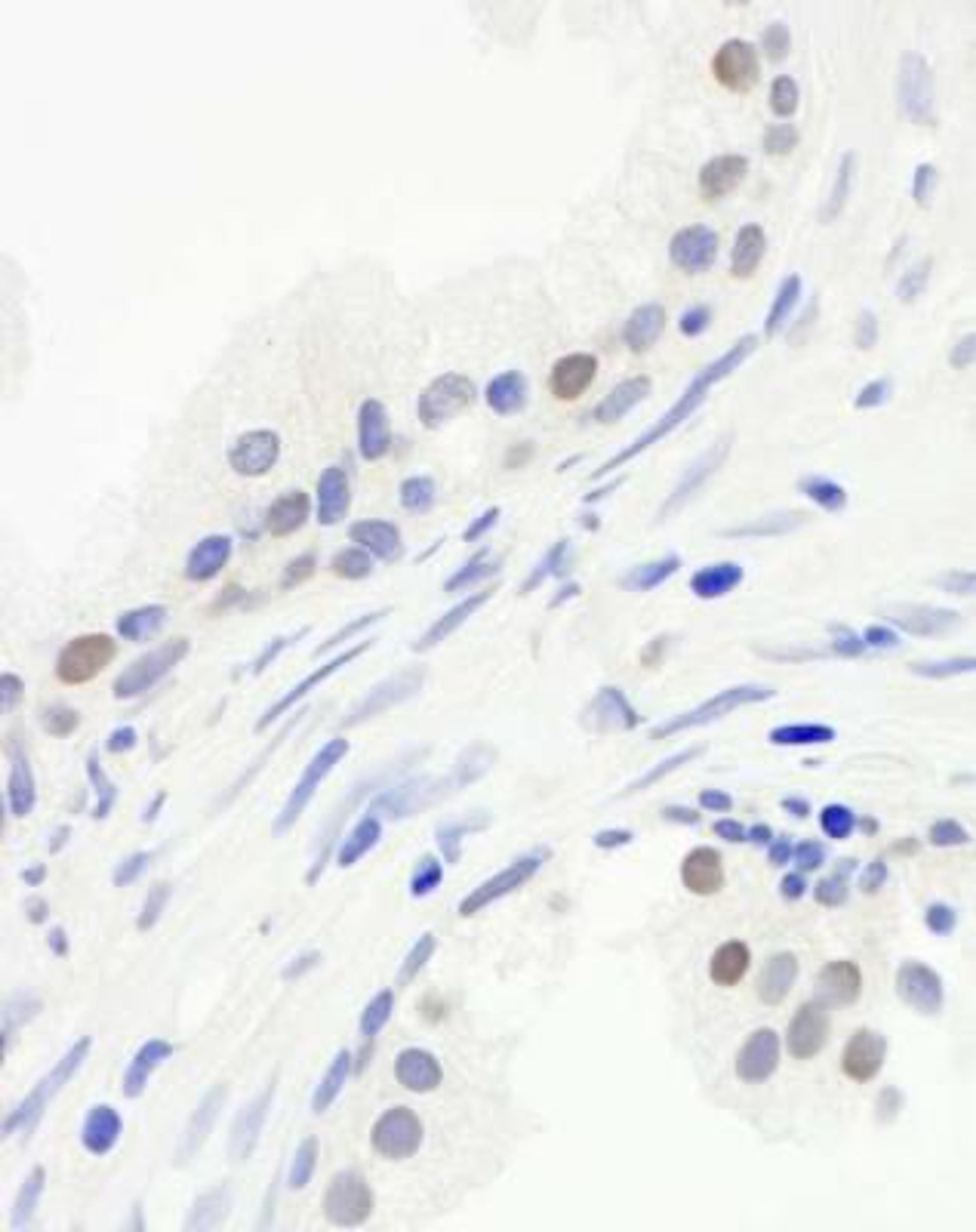 Immunohistochemistry: Cdc20 Antibody [NB100-59827] - FFPE section of human prostate carcinoma.  Antibody used at a dilution of 1:250. Detection: DAB staining using Immunohistochemistry Accessory Kit.