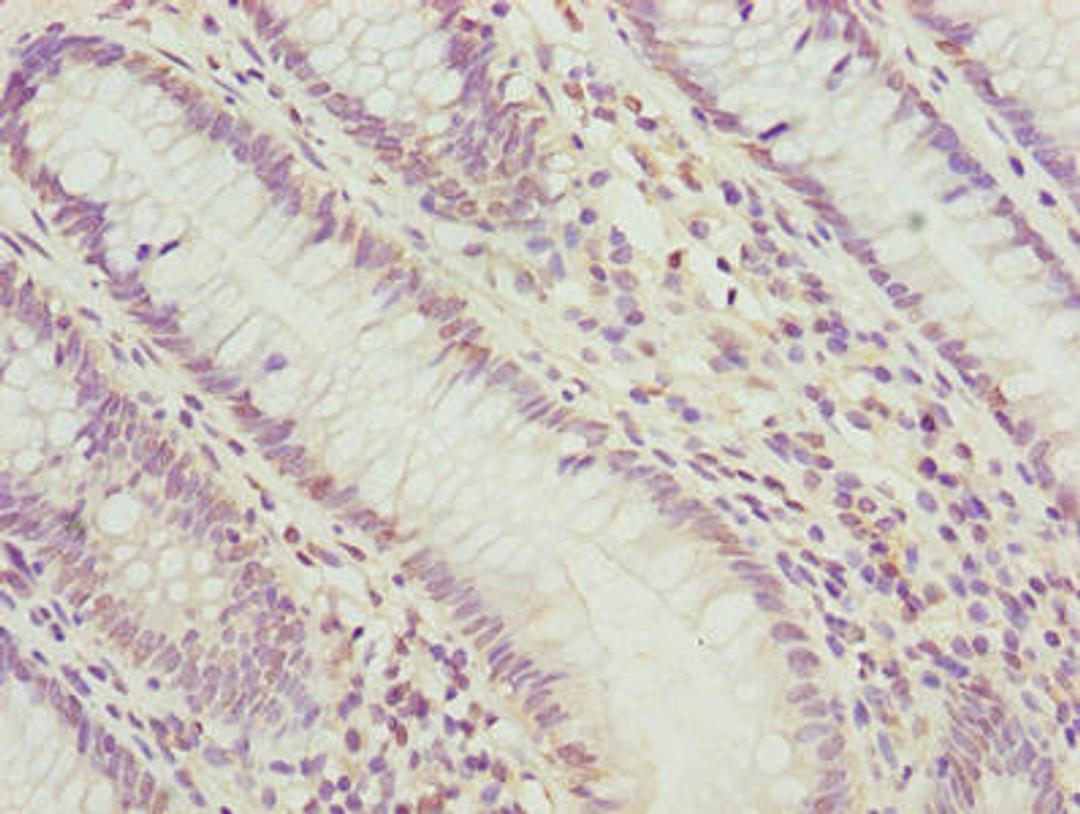 Immunohistochemistry of paraffin-embedded human colon cancer using CSB-PA018193LA01HU at dilution of 1:100