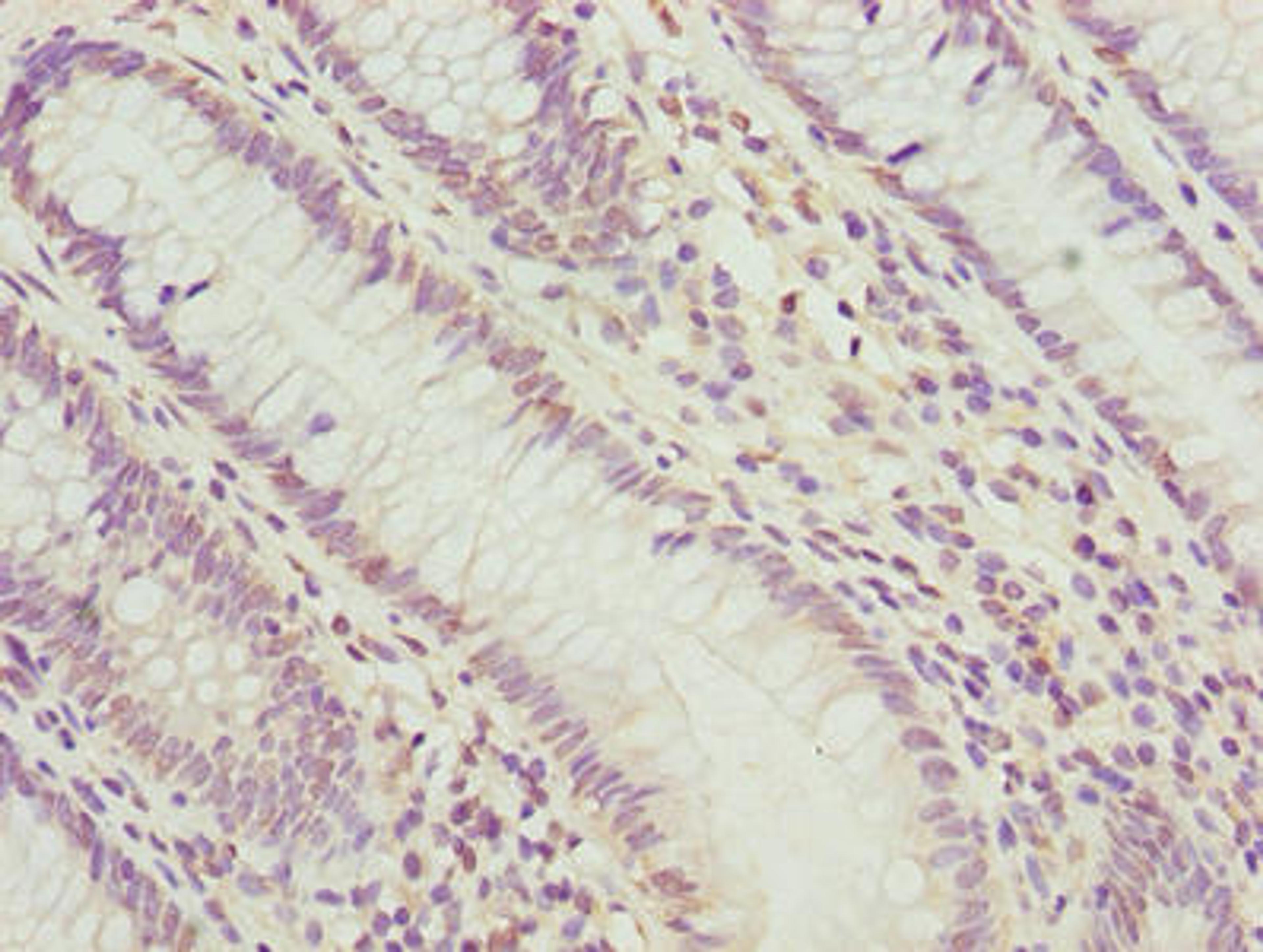 Immunohistochemistry of paraffin-embedded human colon cancer using CSB-PA018193LA01HU at dilution of 1:100