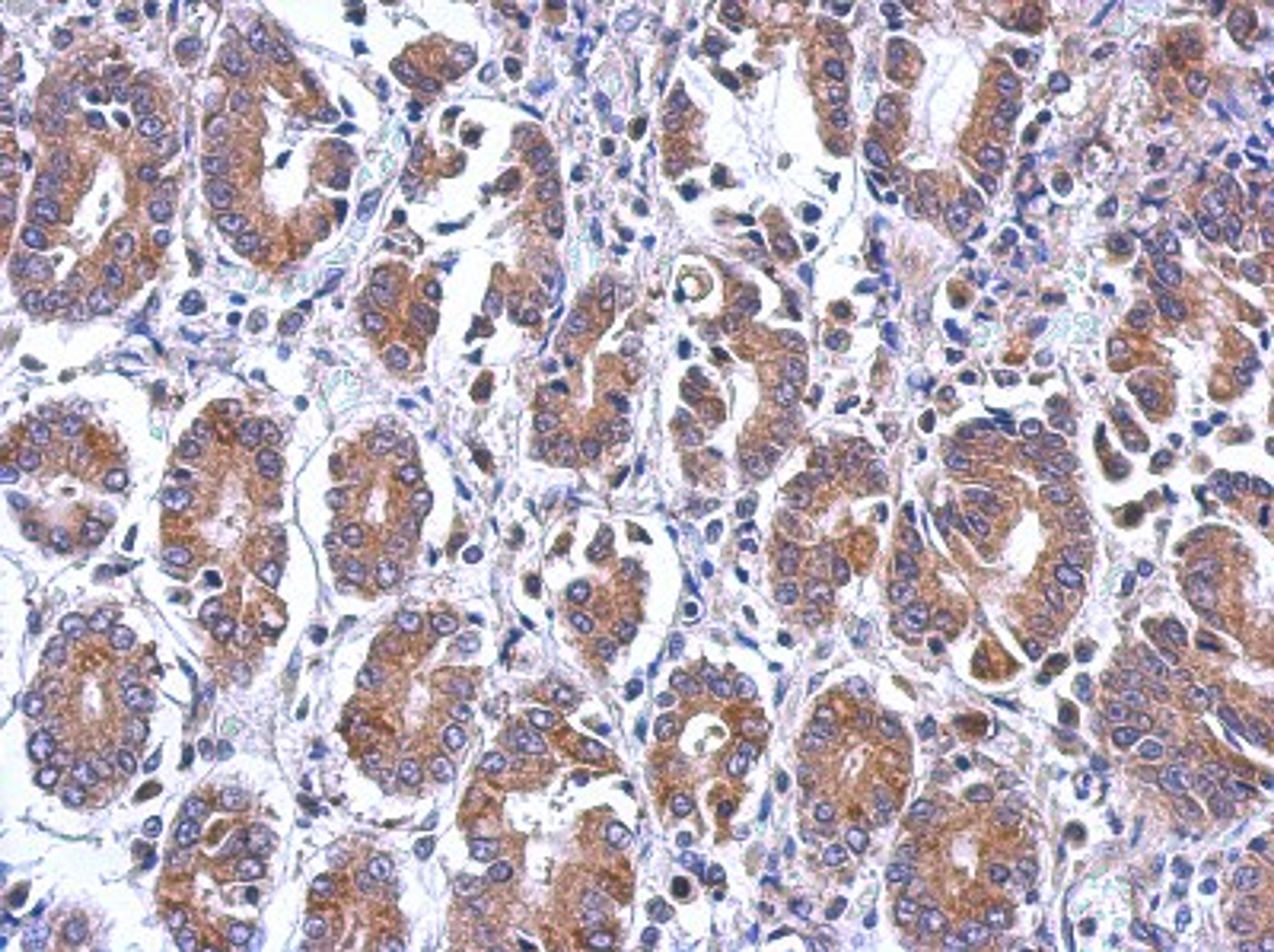 Immunohistochemistry-Paraffin: EIF5 Antibody [NBP2-16311] - Immunohistochemical analysis of paraffin-embedded Colon ca, using antibody at 1:500 dilution.