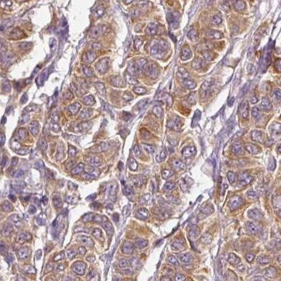 Immunohistochemistry: CTTNBP2 Antibody [NBP2-32030] - breast cancer