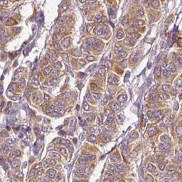 Immunohistochemistry: CTTNBP2 Antibody [NBP2-32030] - breast cancer