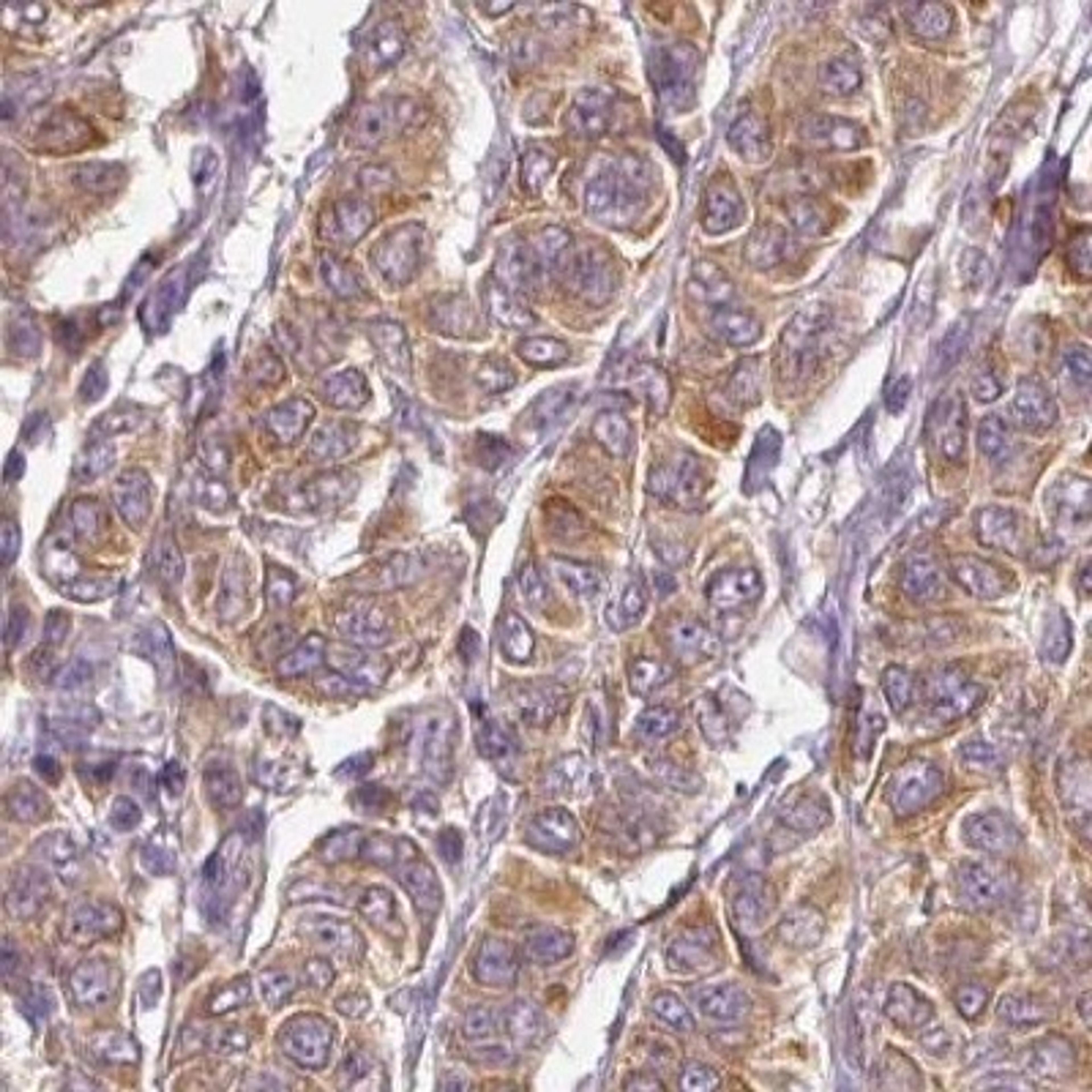 Immunohistochemistry: CTTNBP2 Antibody [NBP2-32030] - breast cancer