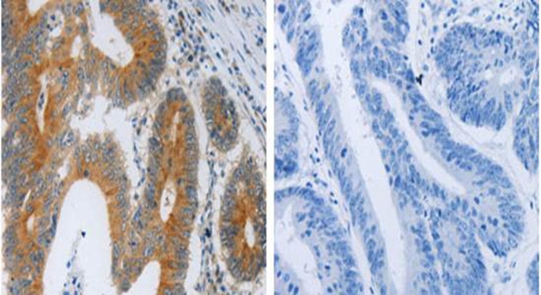 Immunohistochemical analysis of formalin-fixed and paraffin-embedded the image on the left is Human colon cancer tissue at:1:40 dilution and the right is treated with the fusion protein using F2R antibody