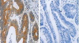 Immunohistochemical analysis of formalin-fixed and paraffin-embedded the image on the left is Human colon cancer tissue at:1:40 dilution and the right is treated with the fusion protein using F2R antibody