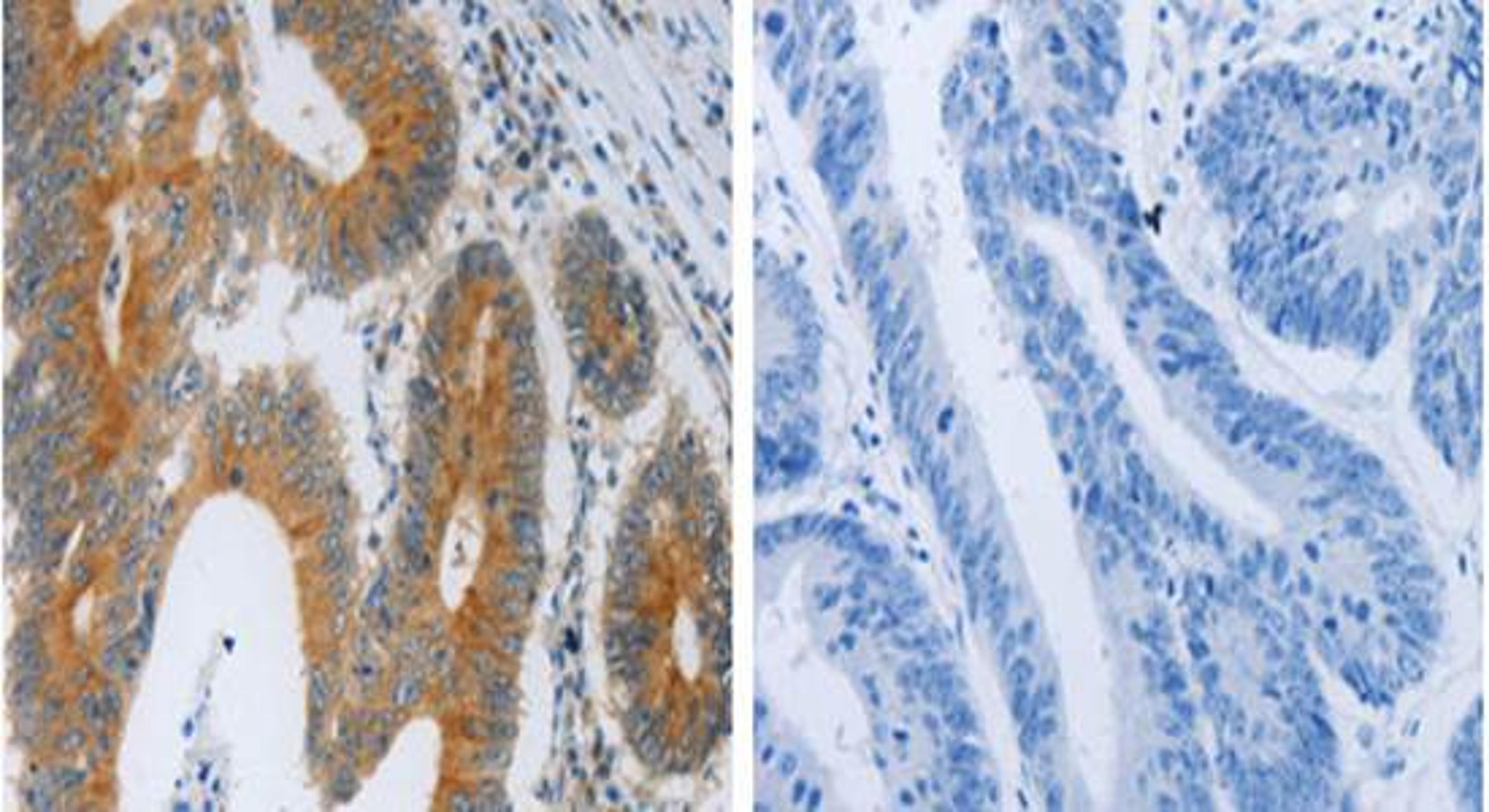 Immunohistochemical analysis of formalin-fixed and paraffin-embedded the image on the left is Human colon cancer tissue at:1:40 dilution and the right is treated with the fusion protein using F2R antibody