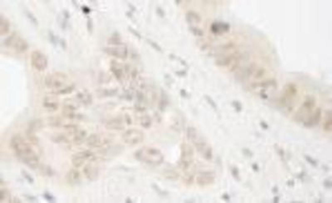 Immunohistochemistry-Paraffin: RAD54L2 Antibody [NBP1-19107] - FFPE section of human colon carcinoma.   Affinity purified rabbit anti-ARIP4 used at a dilution of 1:250.  Detection: DAB staining using Immunohistochemistry Accessory Kit