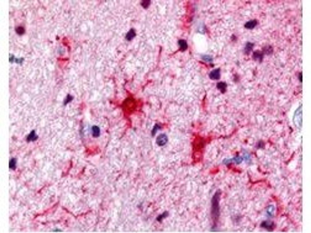 Immunohistochemical staining of human brain astrocyte tumor tissue using S100 Protein antibody