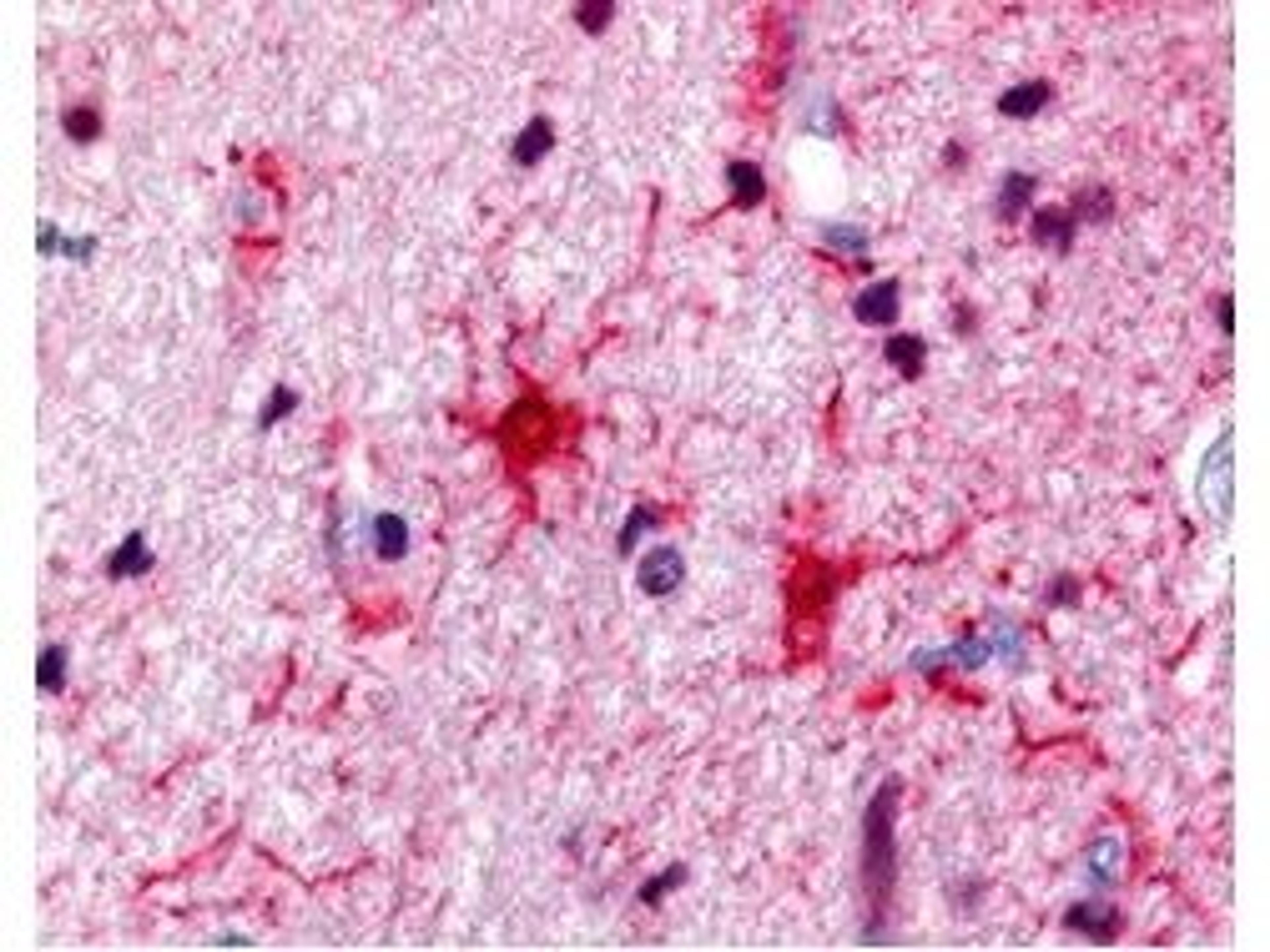 Immunohistochemical staining of human brain astrocyte tumor tissue using S100 Protein antibody