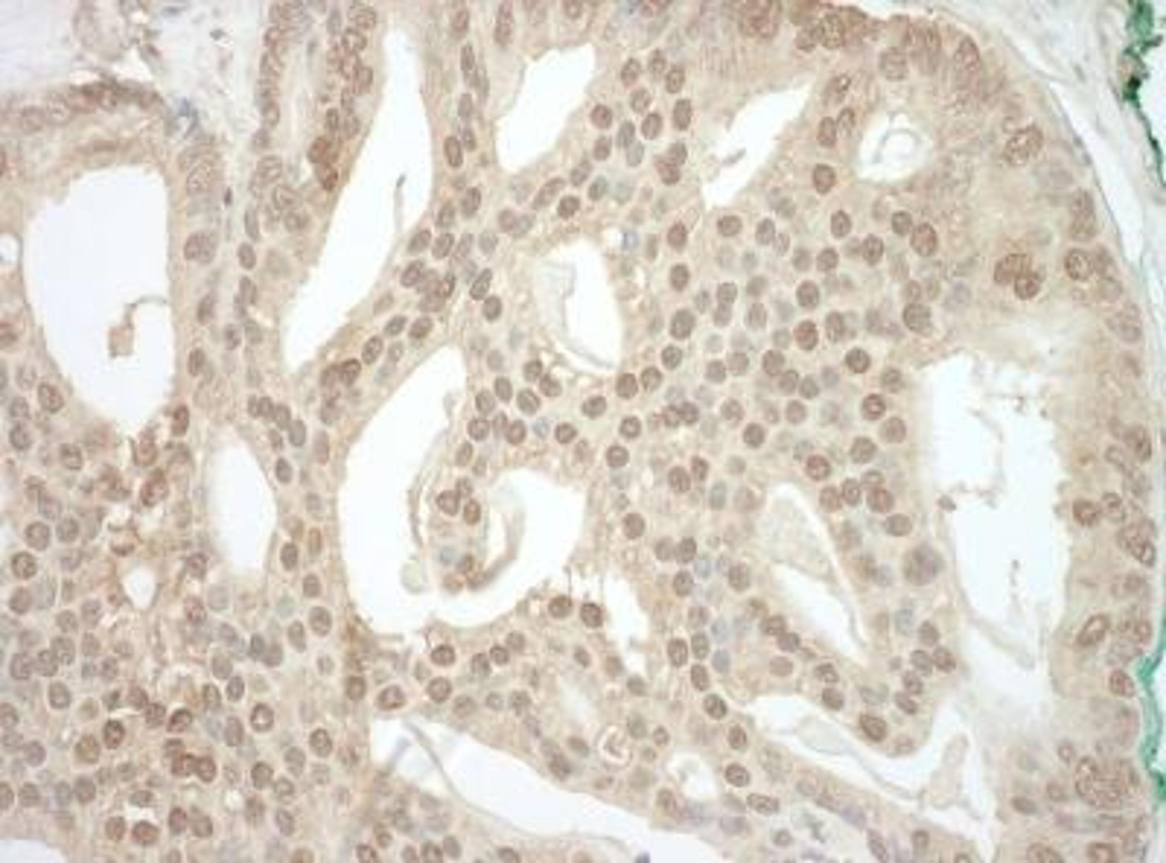 Immunohistochemistry-Paraffin: ADRM1 Antibody [NBP1-30447] - Human prostate carcinoma. Antibody used at a dilution of 1:1000 (1ug/ml).