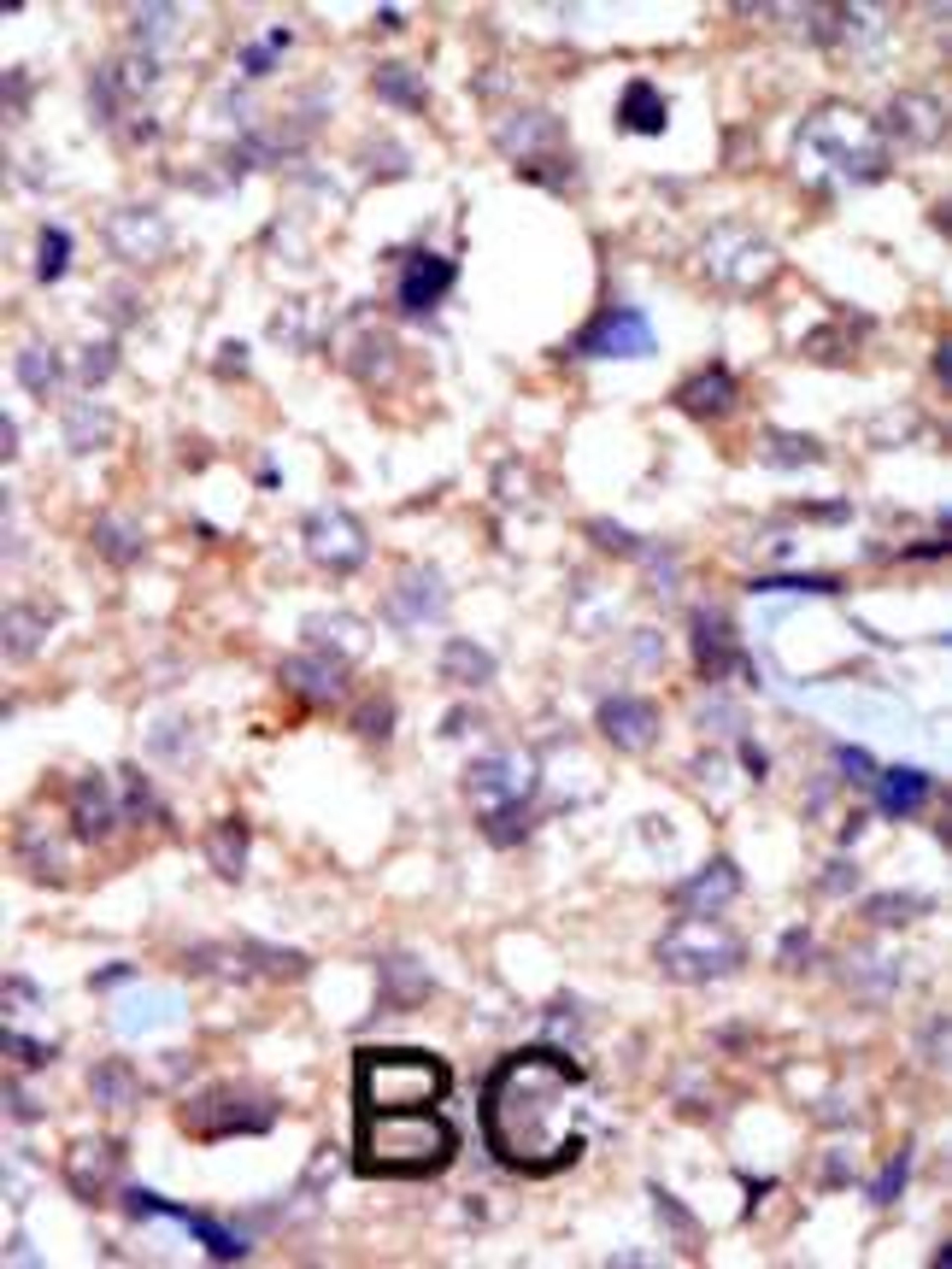 Formalin-fixed and paraffin-embedded human cancer tissue reacted with the primary antibody, which was peroxidase-conjugated to the secondary antibody, followed by AEC staining. BC = breast carcinoma; HC = hepatocarcinoma.