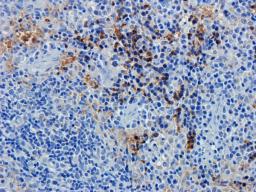 IHC-P staining of human breast cancer tissue using BCL2 antibody (2.5 ug/ml)