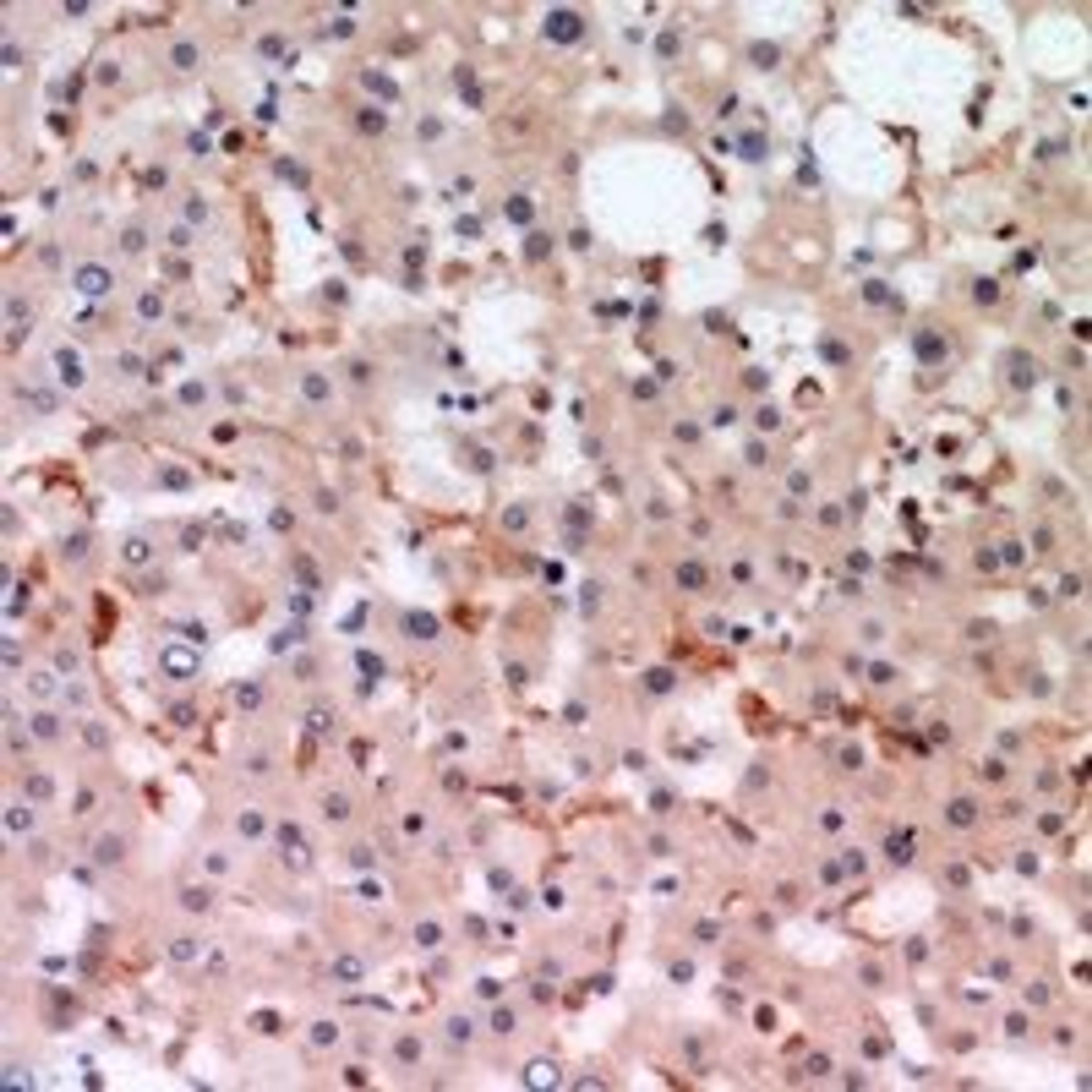 Immunohistochemical staining of human liver cancer tissue using CPAMD1 antibody