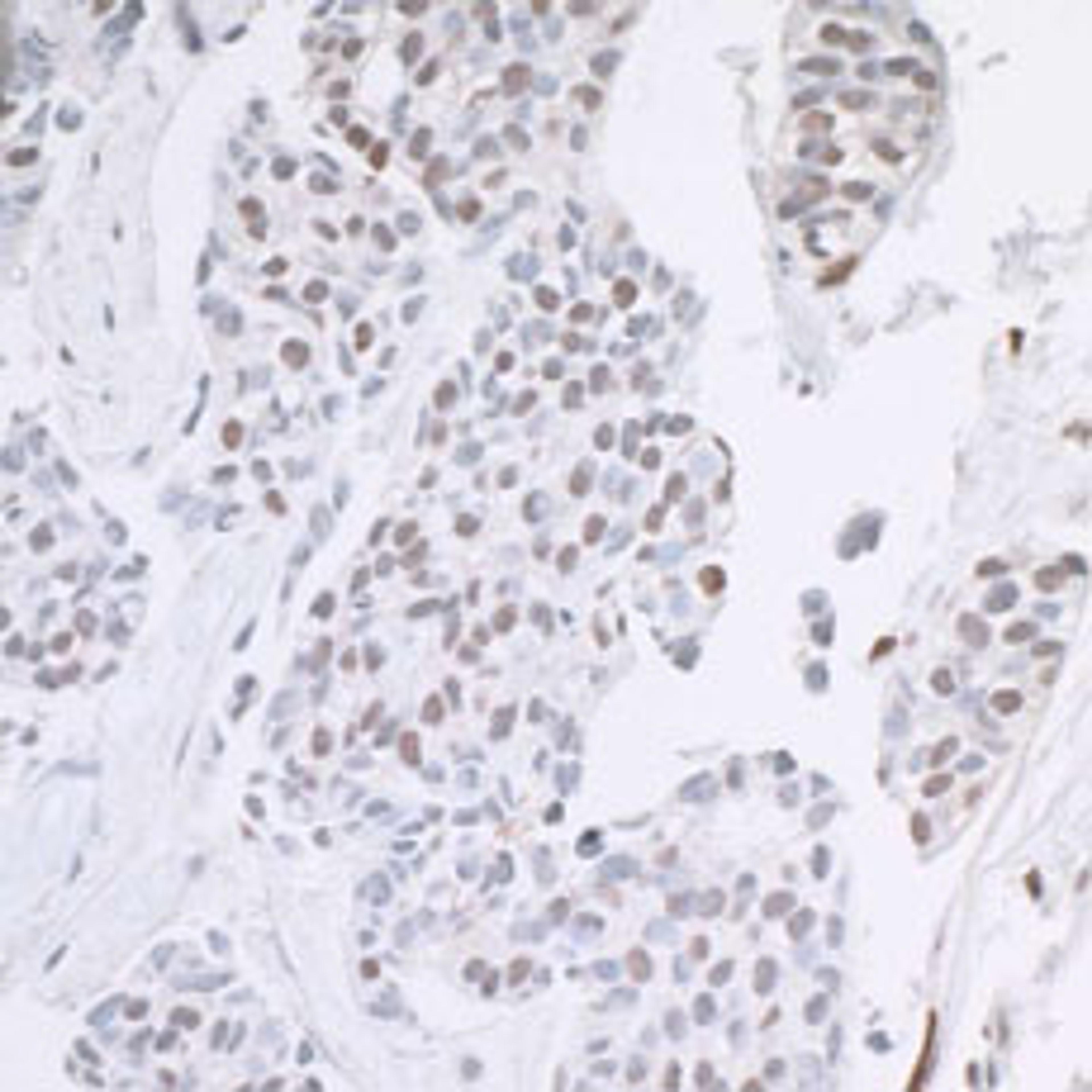 Detection of human ARID1B by immunohistochemistry.