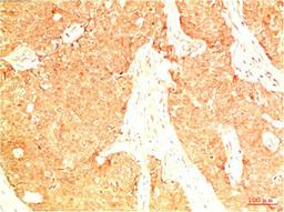 Immunohistochemical analysis of paraffin-embedded Human Breast Carcinoma Tissue using Acetyl P53(K382)  Mouse mAb diluted at 1:200.