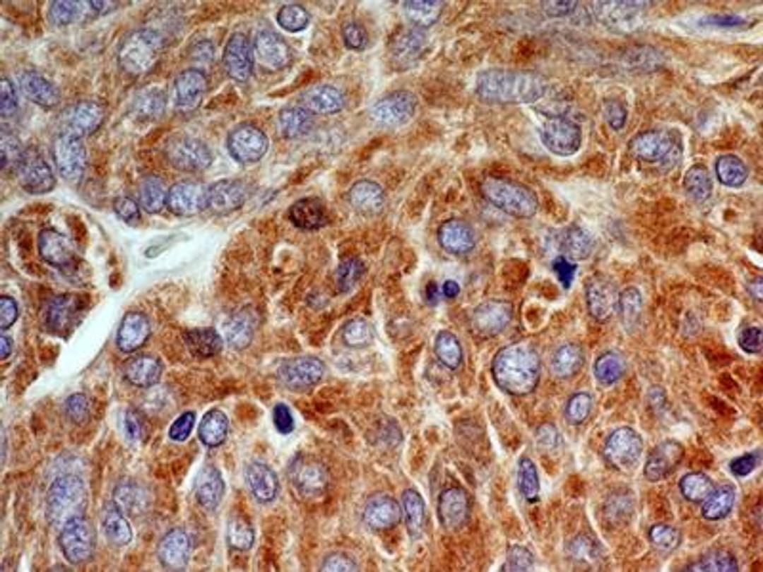 Immunohistochemistry-Paraffin: CCR5 Antibody [NBP2-31374] - IHC-P analysis of CCR5 protein in a section of malignant stromal tumor of small bowel from human using CCR5 antibody at a concentration of 5 ug/ml.