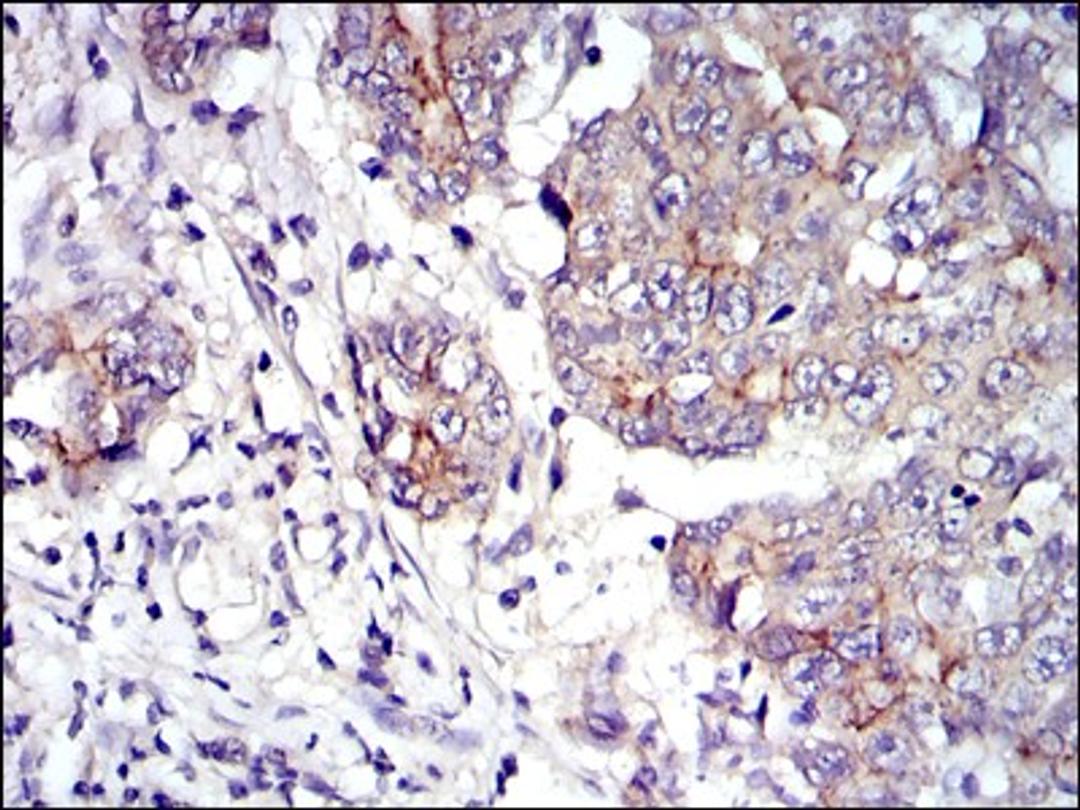 Immunohistochemistry: gamma Catenin Antibody (4C12) [NBP2-37557] - Immunohistochemical analysis of paraffin-embedded stomach cancer tissues using JUP mouse mAb with DAB staining.