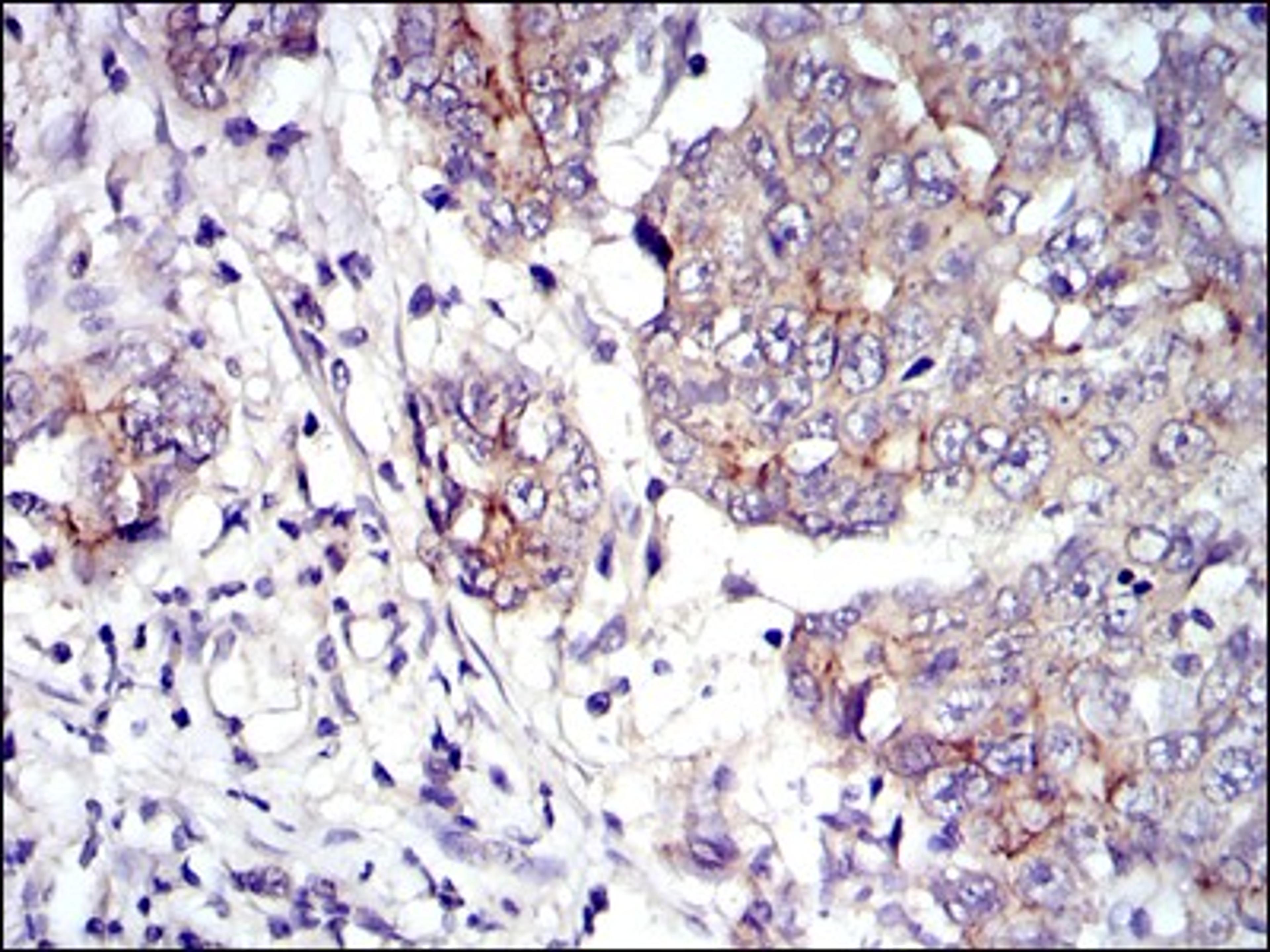 Immunohistochemistry: gamma Catenin Antibody (4C12) [NBP2-37557] - Immunohistochemical analysis of paraffin-embedded stomach cancer tissues using JUP mouse mAb with DAB staining.